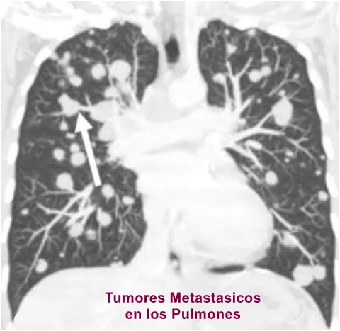 Tumores metastásicos en los pulmones